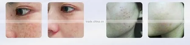 nd yag laser and ipl rf shr comprehensive beauty machine