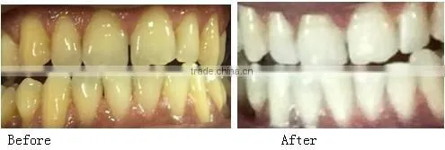 Best Dental Teeth Whitening Product Teeth Whitening Gel Made In USA, teeth cleaning kit