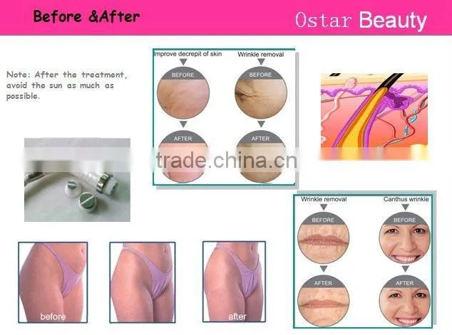 Factory price!! rf lifting new arrival skin tightening machine OB-RF 03