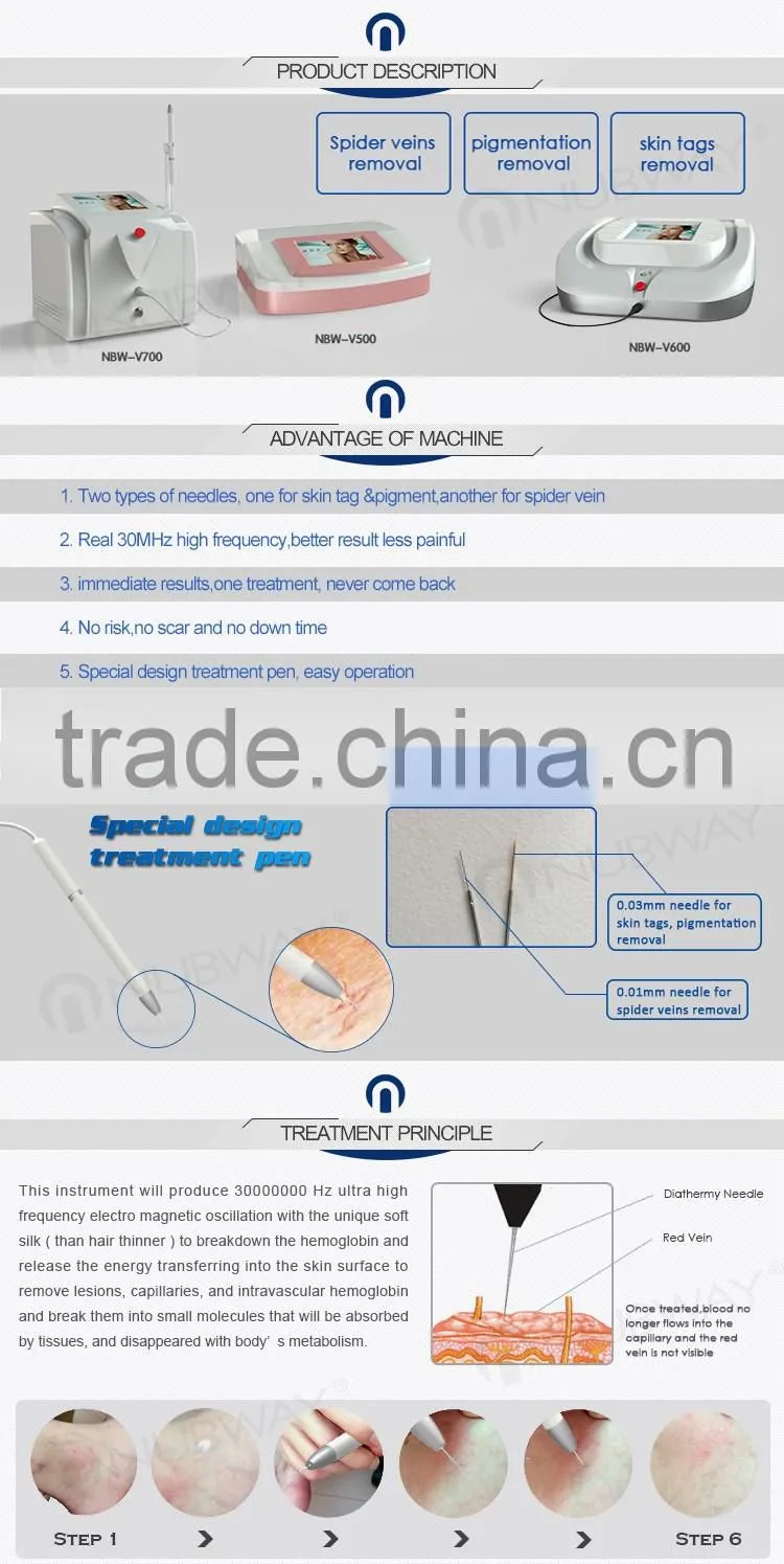 Treatment broken capillaries with 30Mhz high frequency