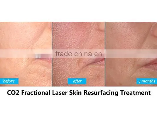 Good quality new technology medical Co2 fractional laser machine for all type skin care