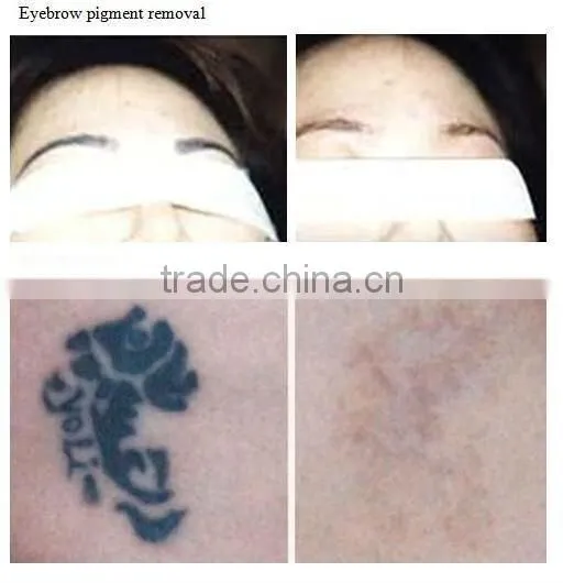 handheld laser hair removal