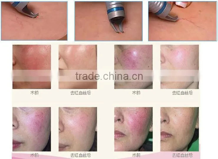 Best selling products 980nm diode laser spider veins removal machine/ high Frequency Spider Vein Removal Machine