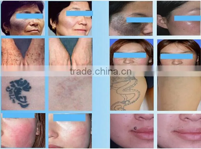 Q-switch Laser ND YAG for Tattoo Removal/laser yag