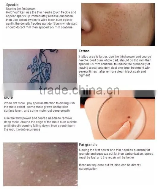 White Laser Removal Scars Laser plasma spots removal pen Removal Scars Beauty newest technology plasma spot removal pen