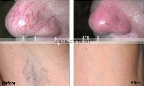 ELOS Beauty Machine Face Skin Treatment 980nm Diode Laser Spider Vein Removal Machine