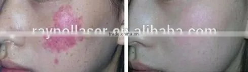 Import Laser Generator 755nm Alexandrite Laser Machines