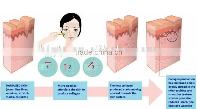 Microneedle Derma roller 1200 With Replaceable roller