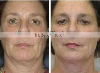 Fractional rf machine with led light for face lifting G-209B