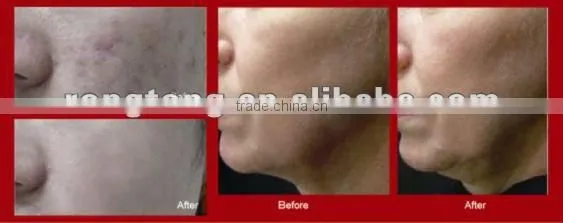 ISO 13485 & Medical CE Approved Water Oxygen Jet + Microdermabrasion 2 in 1 System