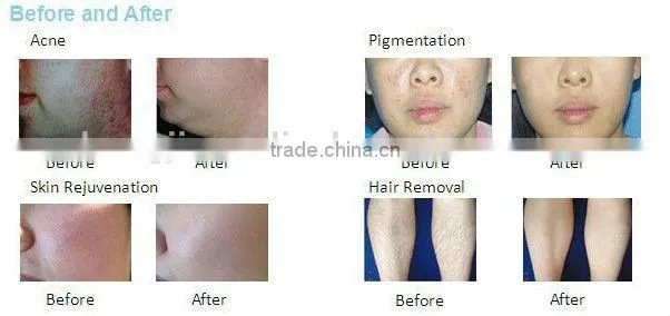 promote sale!! 2015 new product led photon light therapy device for whole body care