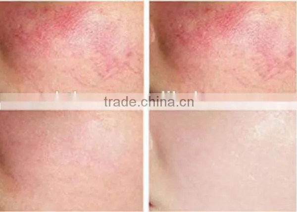 Adjustable 1mm ,2mm ,3mm diameter 980nm Diode Laser Blood Vascular Removal And Spider Vein Treatment Machine