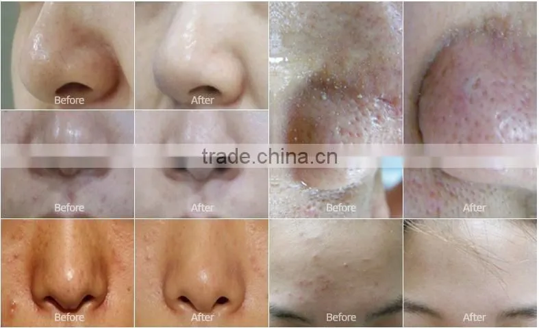 NL-SPA600 Hot sale LED PDT 7 Colors Skin Rejuvenation Equipment With PDT LED Light Therapy Principle