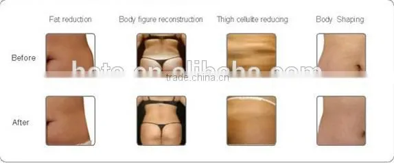 Guangzhou HETA New arrival I-lipo laser equipment lipo laser weight measuring device
