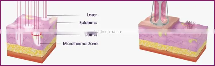 beauty machine scar removal scar treatment co2 for wholesales