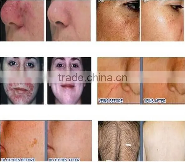 TOP SALES!! NUBWAY new design good quality 3 handles ipl handpiece skin treatment system for sale
