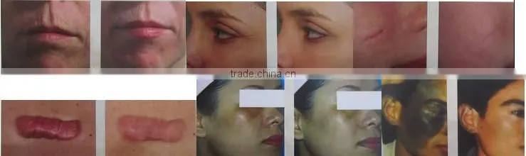 best 30W RF Tube Laser scar removal Laser CO2 Fractional