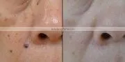 Newest !!! luxury fractional co2 laser acne scar removal