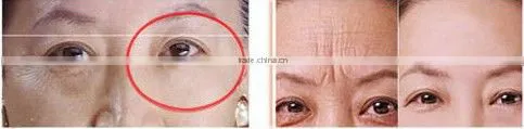 antiwrinkle Radio Frequency Machine for skin tightening