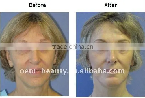Portable IPL hair removal beauty device A003