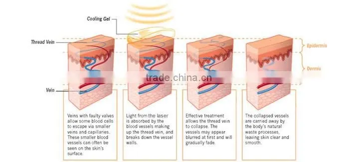 Total counts 20.000.000 shots diode laser 980nm vascular removal machine
