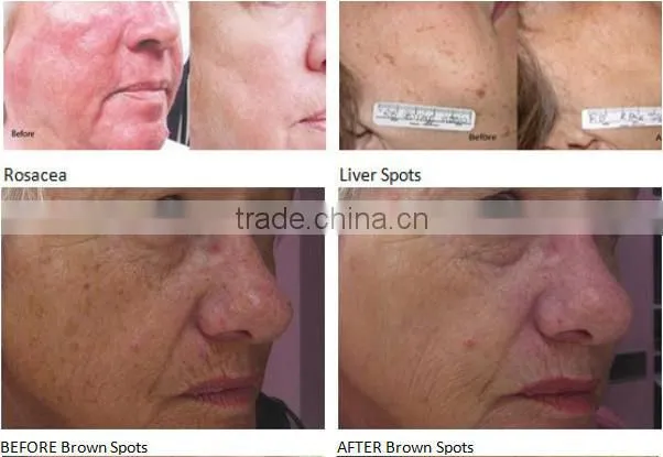 Best IPL Skin Rejuvenation/Anti Ageing ipl laser machine