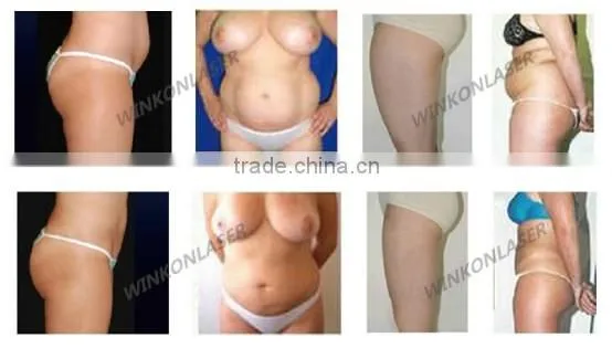 non-invasive liposuction machine / fat freezing machine / fat reducing machine