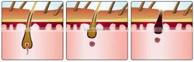 CE Certificated Fast hair removal IPL diode laser wrinkle and ance removal with teaching video
