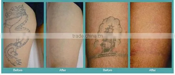 active laser tattoo removal have the best treatment results