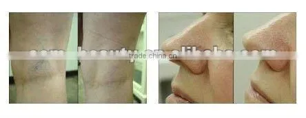 Portable Mobile Spa Equipment 1064nm Laser Hair Removal Machine -P003