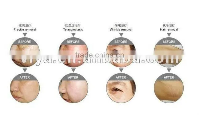 VY-E80 E Light IPL RF System with laser