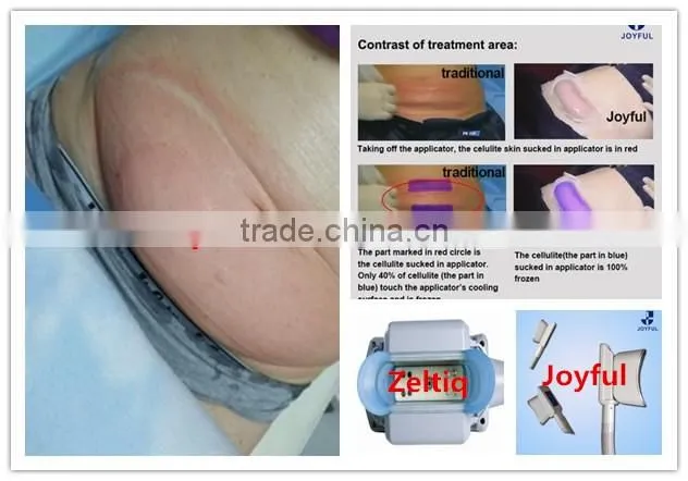 fat freeze cavitation cryotherapy machine for home use