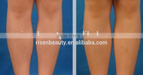 Professional SHR IPL machine ,permanent hair removal /SHR IPL machine keyword 2015 best shr ipl machine for beauty use