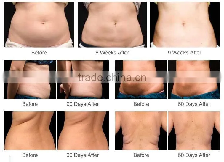 High Quality!! Two Cool Handles Working at Same Time Fat Freeze Machine Cryolipolysis Lose Weight with Teaching Video
