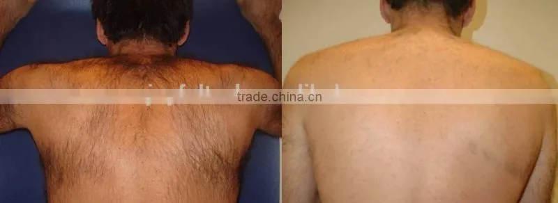 Foot switch laser machine diode 808 for hair removal