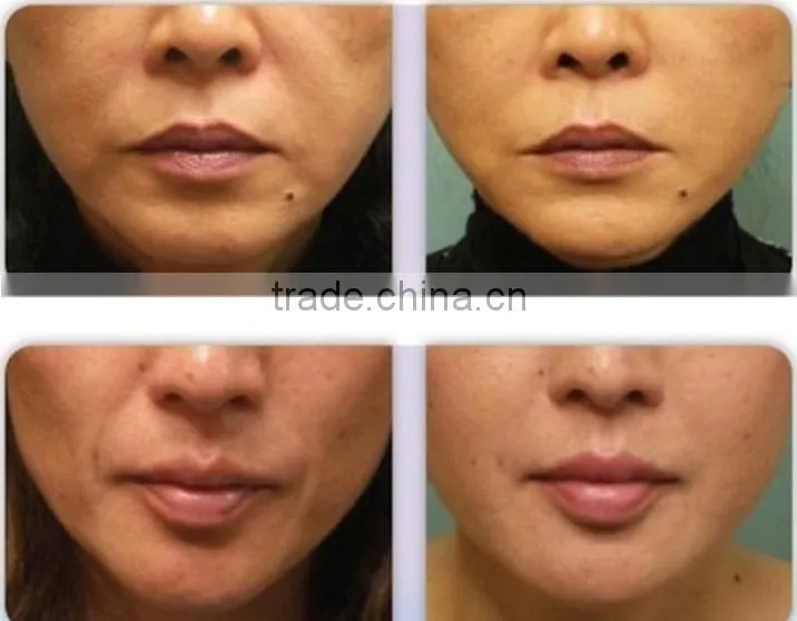 Fractional RF CPT Face Lift Wrinkle Removal Radio Frequency Beauty Salon Equipment