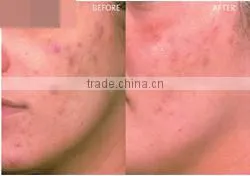 M-D6 Facial SPA water dermabrasion peel off dead skin water skin
