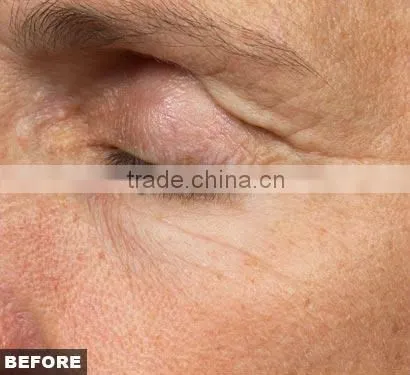 Hot Fractional & Micro needle RF machine wrinkle removal, face lifting/fractional microneedle radiofrequency
