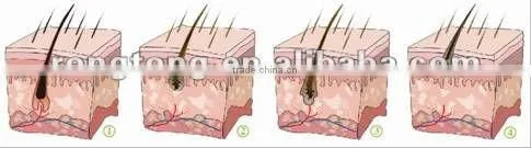 move business ipl medical spa equipment
