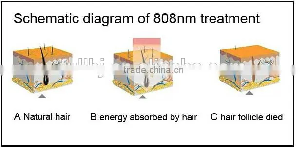 permanent hair removal/Professional New Diode 808nm Laser Hair Removal machine