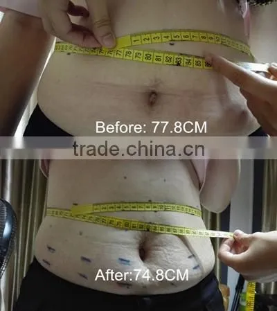 GLM Ultrasonic HIFU fat reduction HIFU body slimming