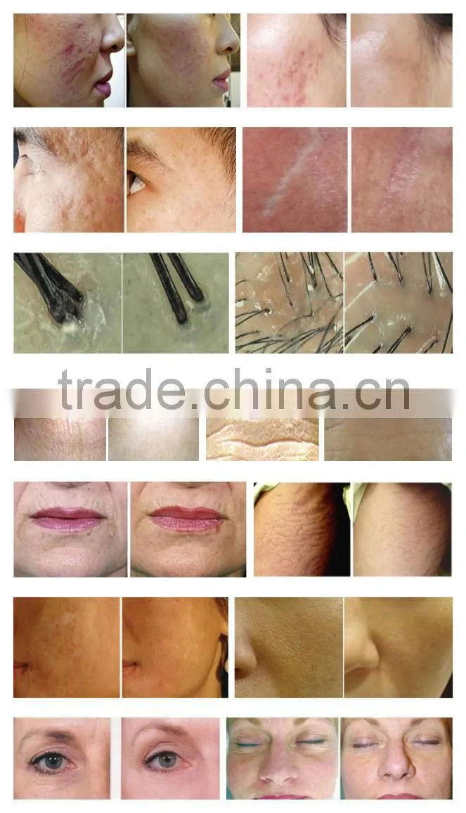 GTO200 face derma roller/skin care roller/beauty roller(CE approved)