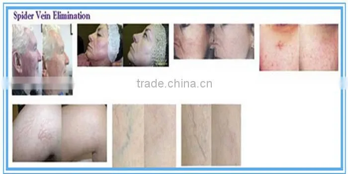 CE Approval Long pulse 1064nm nd yag laser permanent hair removal and Spider Vein removal