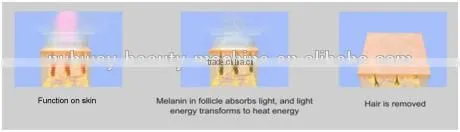 Intense pulsed light acne removal blue light therapy for acne