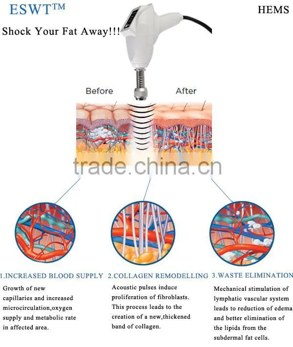 ESWT-70 Slimming Liposuction Beauty Machine (ESWT Shockwave & Cyclone RF)