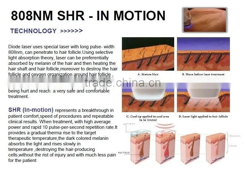KLSi Diode Lightsheer Laser Hair Removal (808)