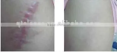 Q Switch ND.YAG Medical Laser tatoo removal Beauty machine