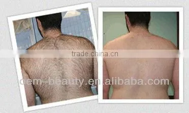 2013 latest technology medical laser hair removal equipment P003