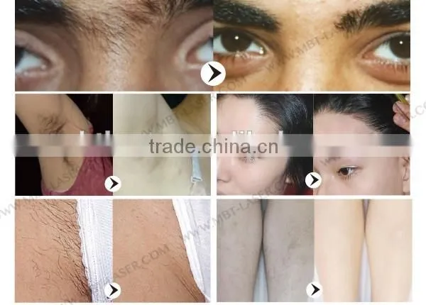 IPL SHR hair removal machine / SHR hair removal