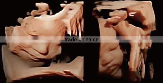 CE approved Portable Color Ultrasound Scanner with Optional 4D function( Q9)